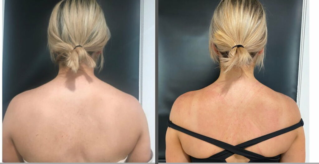 trapezius botox before-after Los Angeles