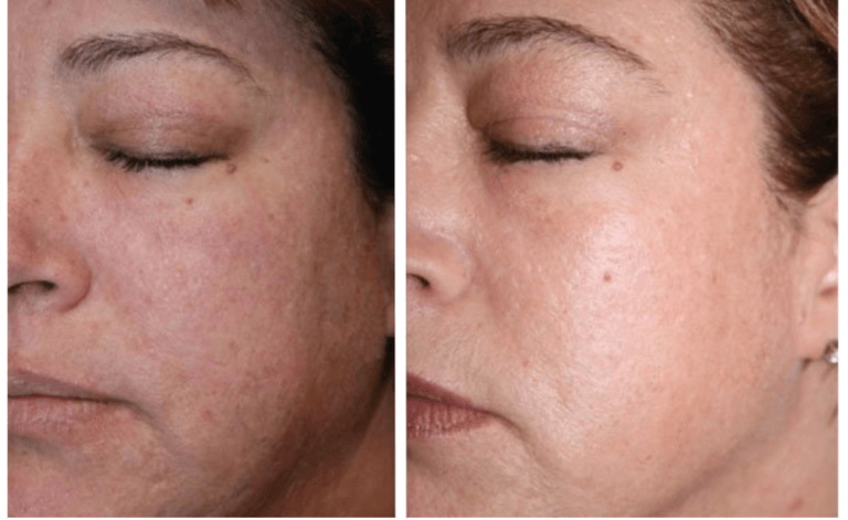 Coolpeel before-after Los Angeles