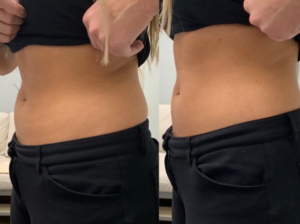 Non-Surgical Fat Reduction with Morpheus8 before-after Los Angeles