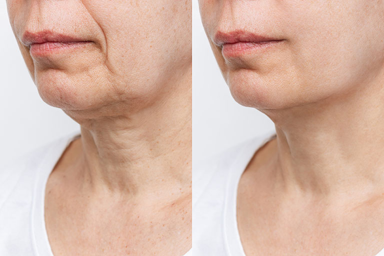 thread lift for sagging jowls before-after Los Angeles