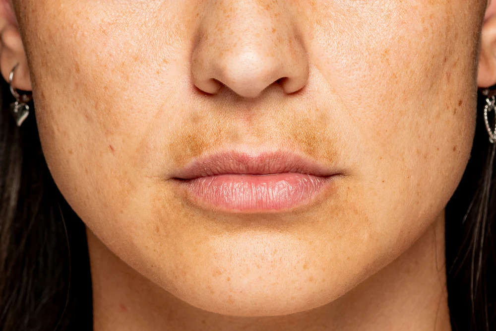 What is uneven skin tone Los Angeles