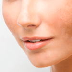 benefits of Lumecca IPL in treating dyschromia Los Angeles