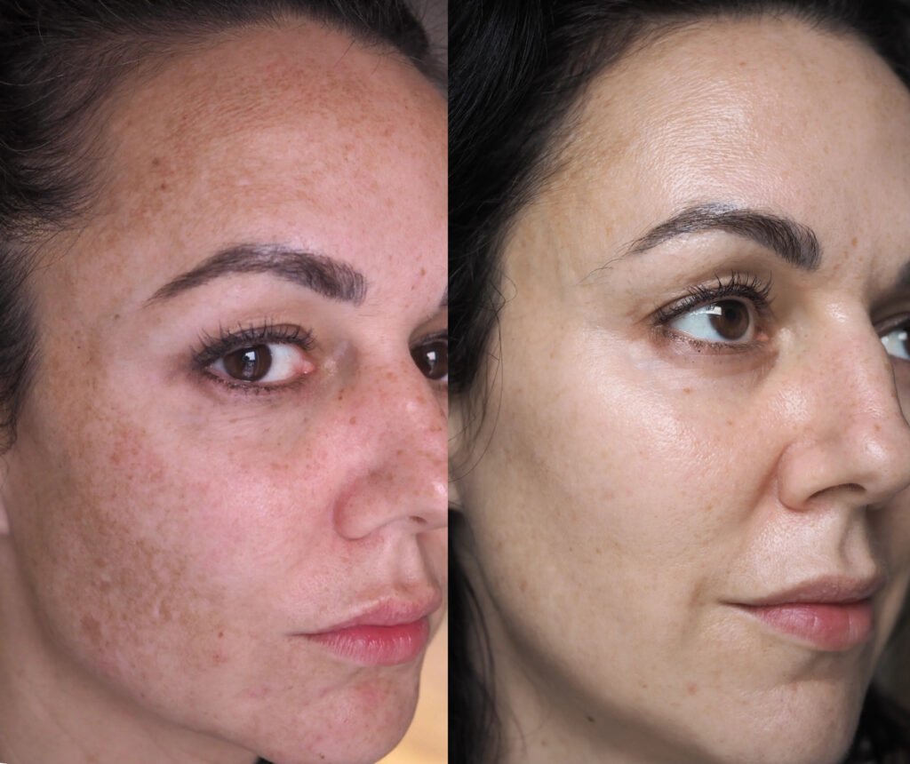 pigmentation treatment with Lumecca IPL before-after Los Angeles