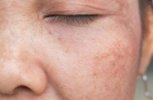 skin pigmentation Los Angeles 