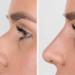 Dermal fillers for non-surgical rhinoplasty before-after Los Angeles