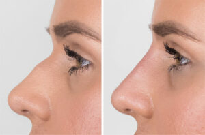 Dermal fillers for non-surgical rhinoplasty before-after Los Angeles