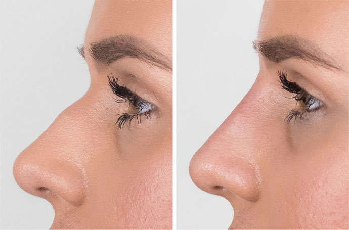 Dermal fillers for non-surgical rhinoplasty before-after Los Angeles