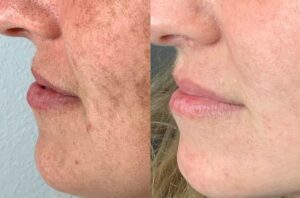 Lumecca IPL for brown spots before-after Los Angeles