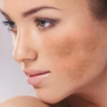 Lumecca IPL for brown spots on the skin Los Angeles