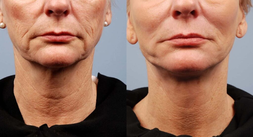 Morpheus8 for neck lift before-after Los Angeles