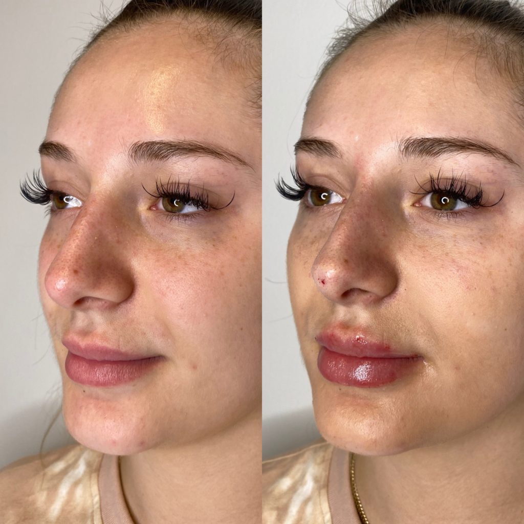 PDO threads for nose reshaping before-after Los Angeles