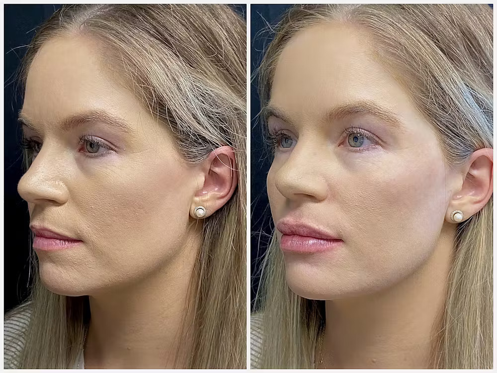 dermal fillers before-after Los Angeles