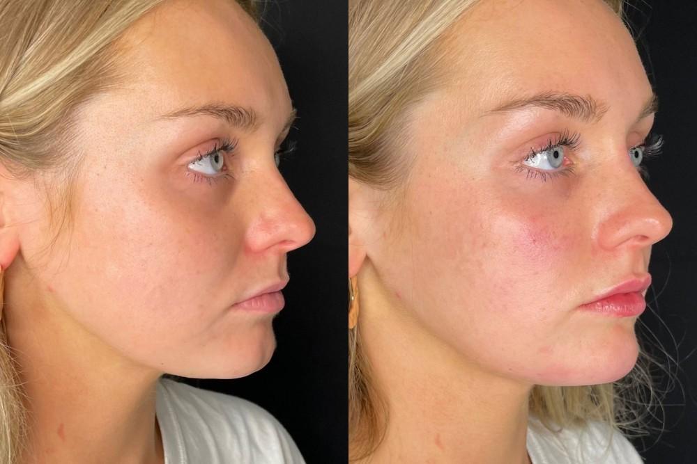 facial balancing with dermal fillers before-after Los Angeles