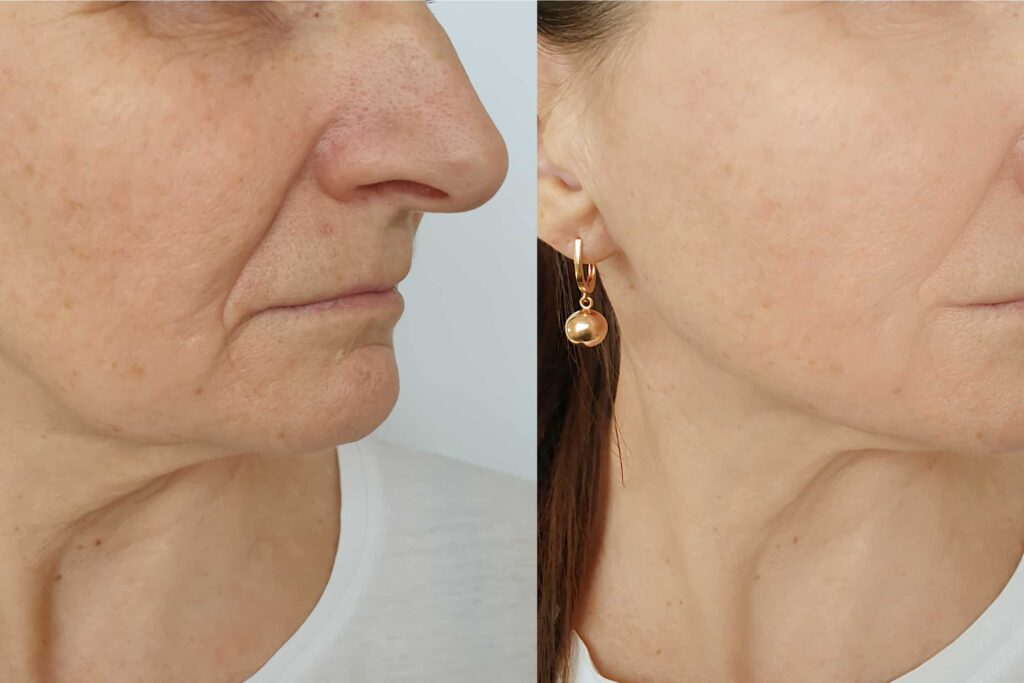 neck tightening treatment before-after Los Angeles