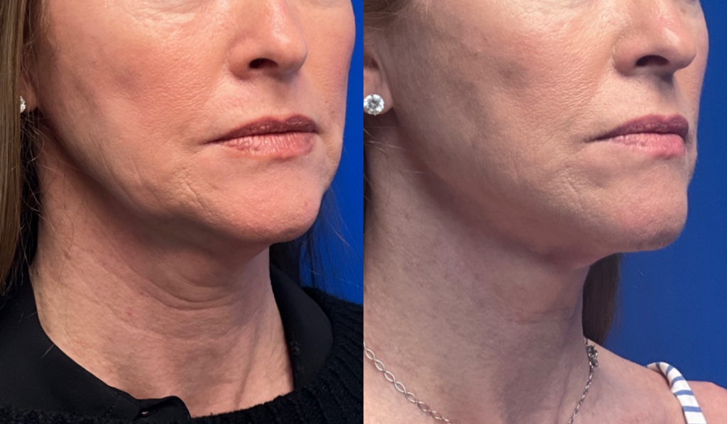 non-surgical neck lift Los Angeles