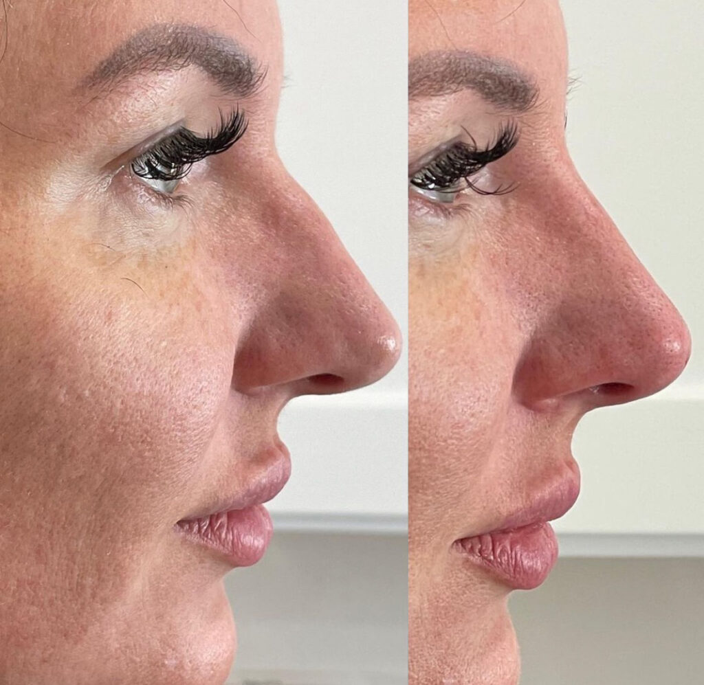 non-surgical nose job with PDO threads before-after Los Angeles