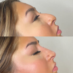 nose-filler before-after Los Angeles