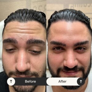 dysport injections forehead