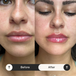 Best lip enhancement Hollywood