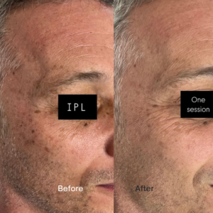 IPL Laser for dark spots