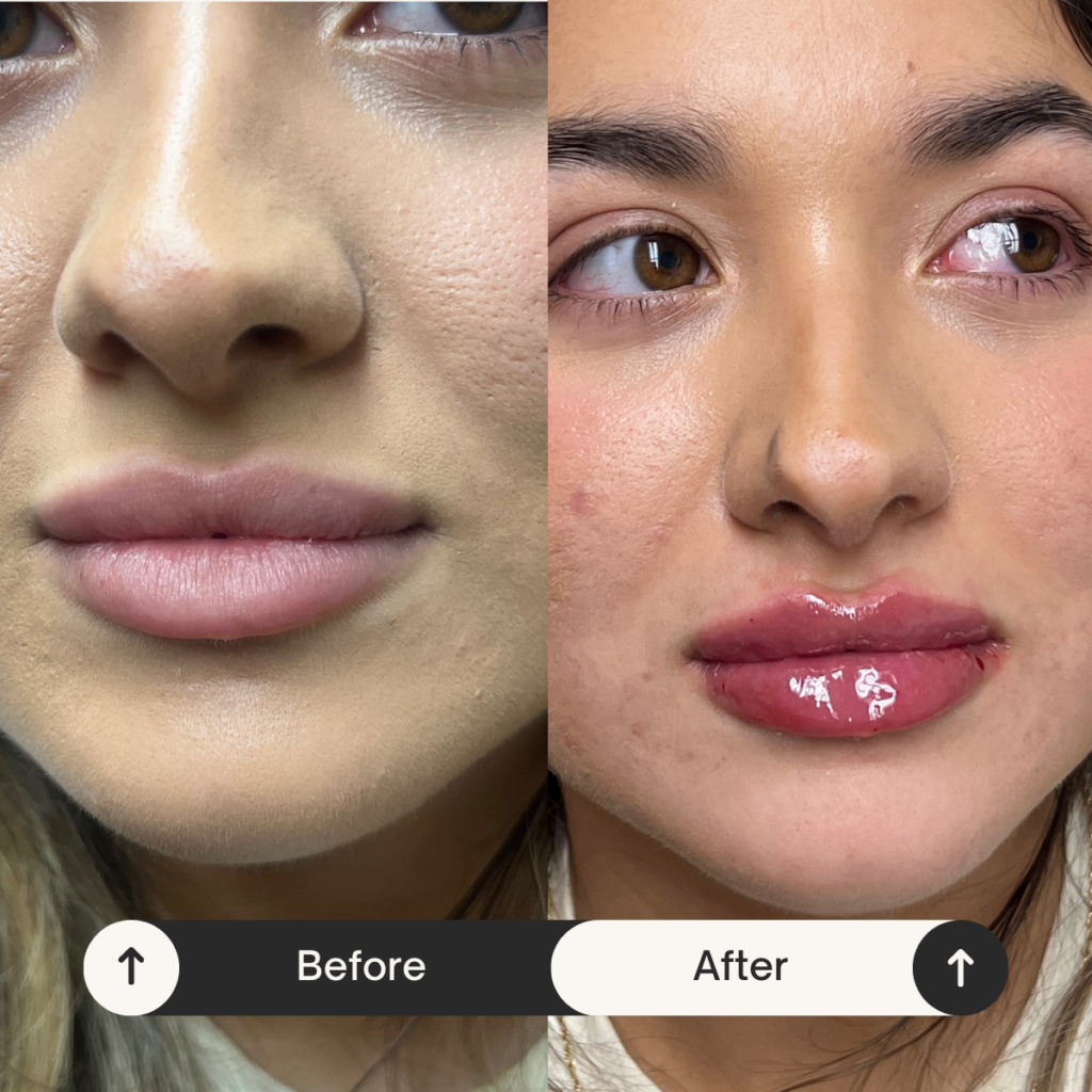 filler injections before and after