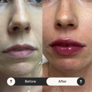 lip enhancement Hollywood