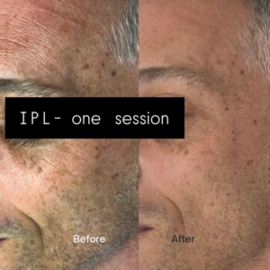 Lumecca IPL for dark spots