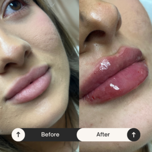 filler injections Los Angeles