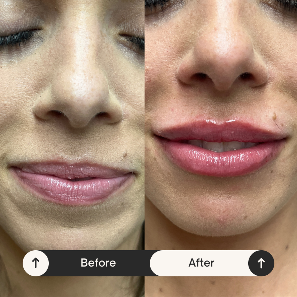 best lip injections Los Angeles