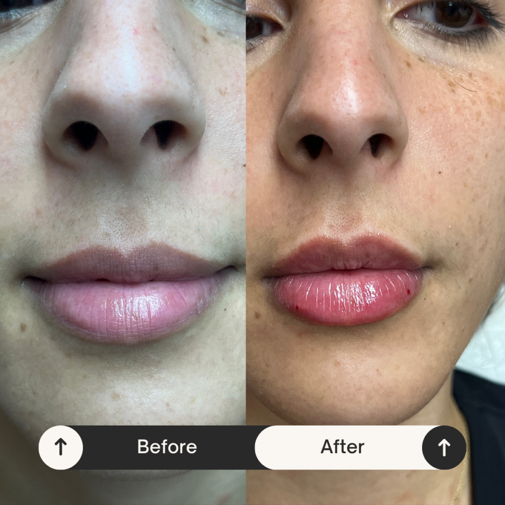 best lip injections Los Angeles