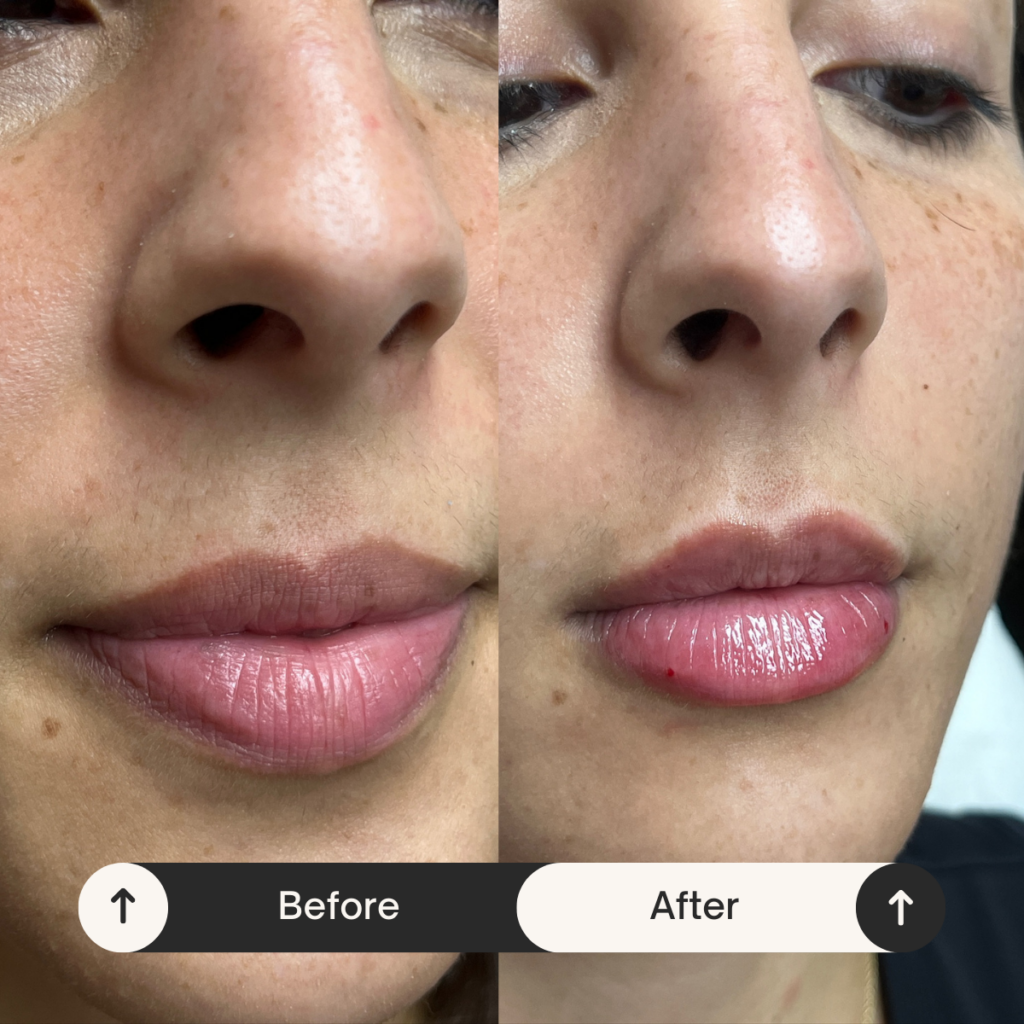 lip injections Los Angeles