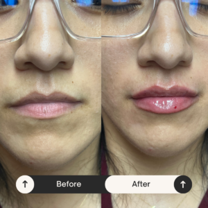 lip injections Los Angeles