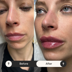 lip injections Los Angeles