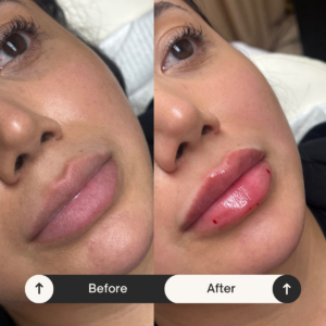 lip injections Los Angeles