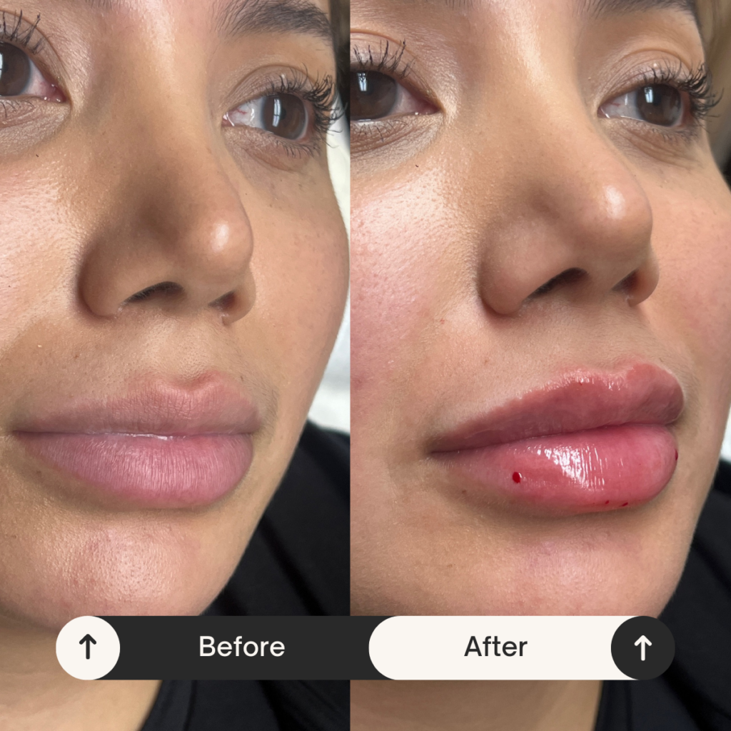 lip injections Los Angeles