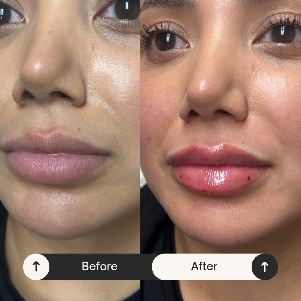 lip fillers Los Angeles