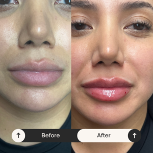 lip fillers Los Angeles