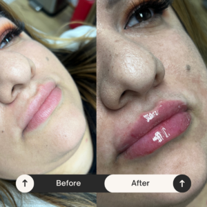 lip fillers Los Angeles