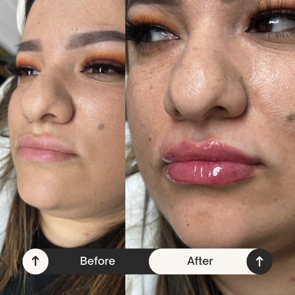 lip fillers Los Angeles