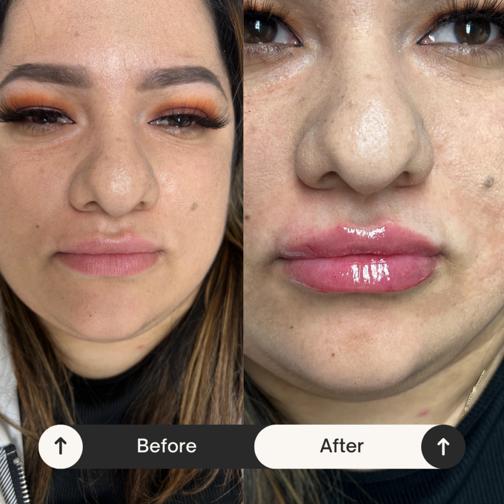 lip fillers Los Angeles