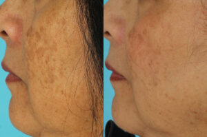 Brown spots-before-after Los Angeles 