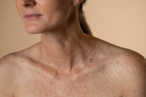 Brown spots on the décolleté and on the breasts Los Angeles 