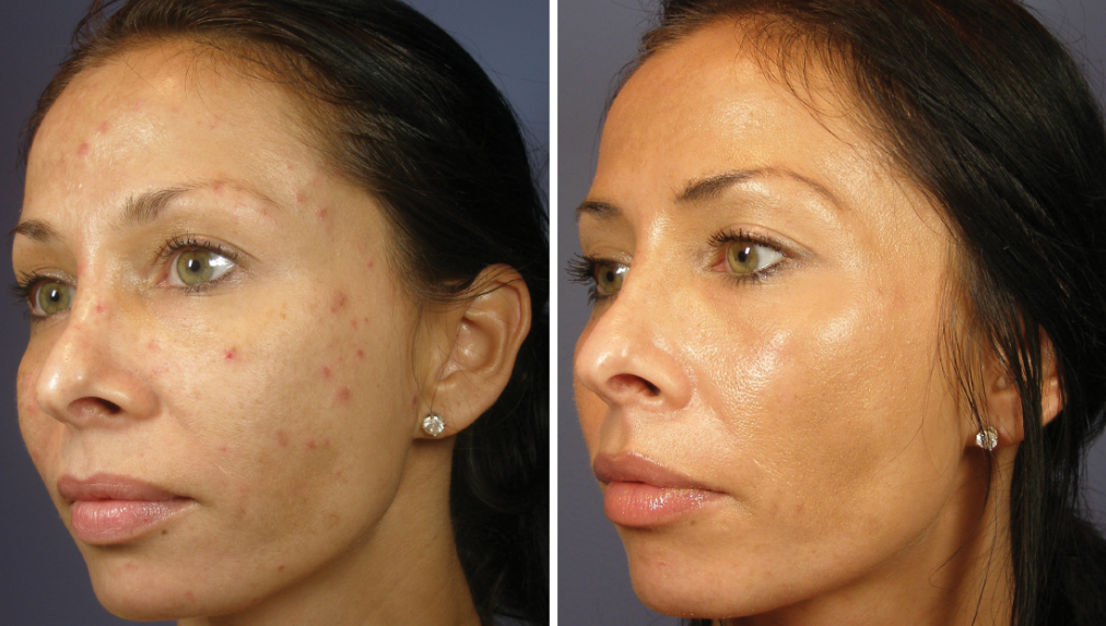 Chemical peel before-after Los Angeles