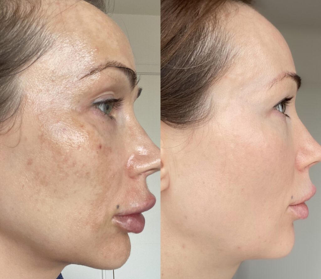 Cosmelan-Peel-Before-After-Skin-Care-Treatment Los Angeles