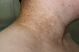 Dark-Neck-dark patches on skin Los Angeles 