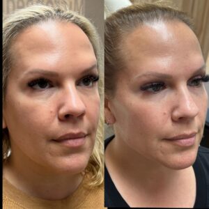 facial treatment for pigmentation