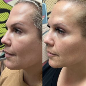 IPL laser for face Los Angeles