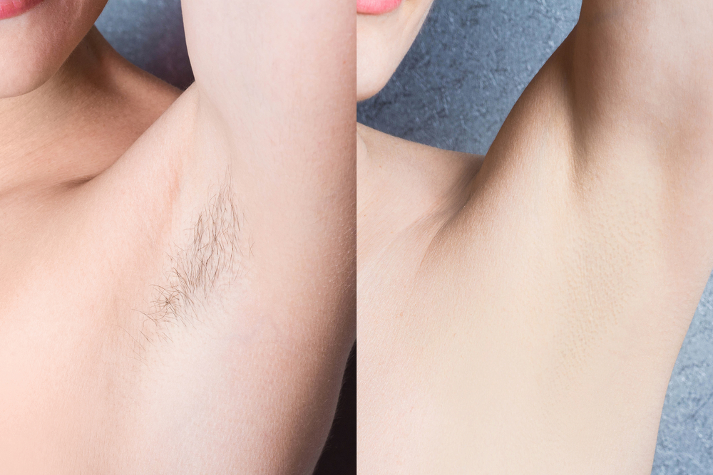 Laser hair removal -before-and-after Los Angeles