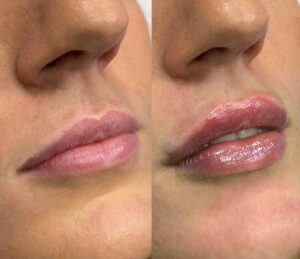 Lip-enhancement-results Los Angeles