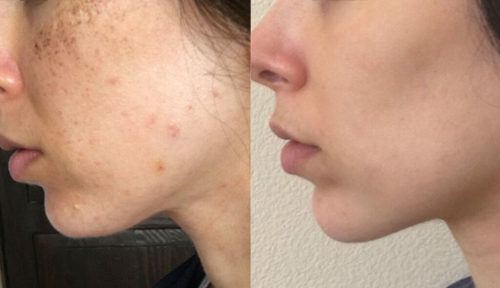 Lumecca IPL skin care treatment before-after Los Angeles